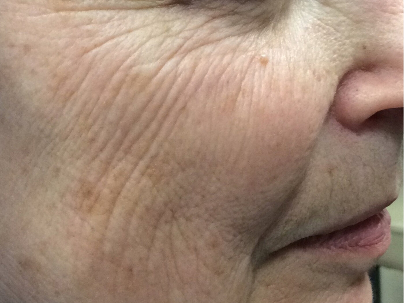 After laser treatment showing softer creasing and smoother cheek texture.