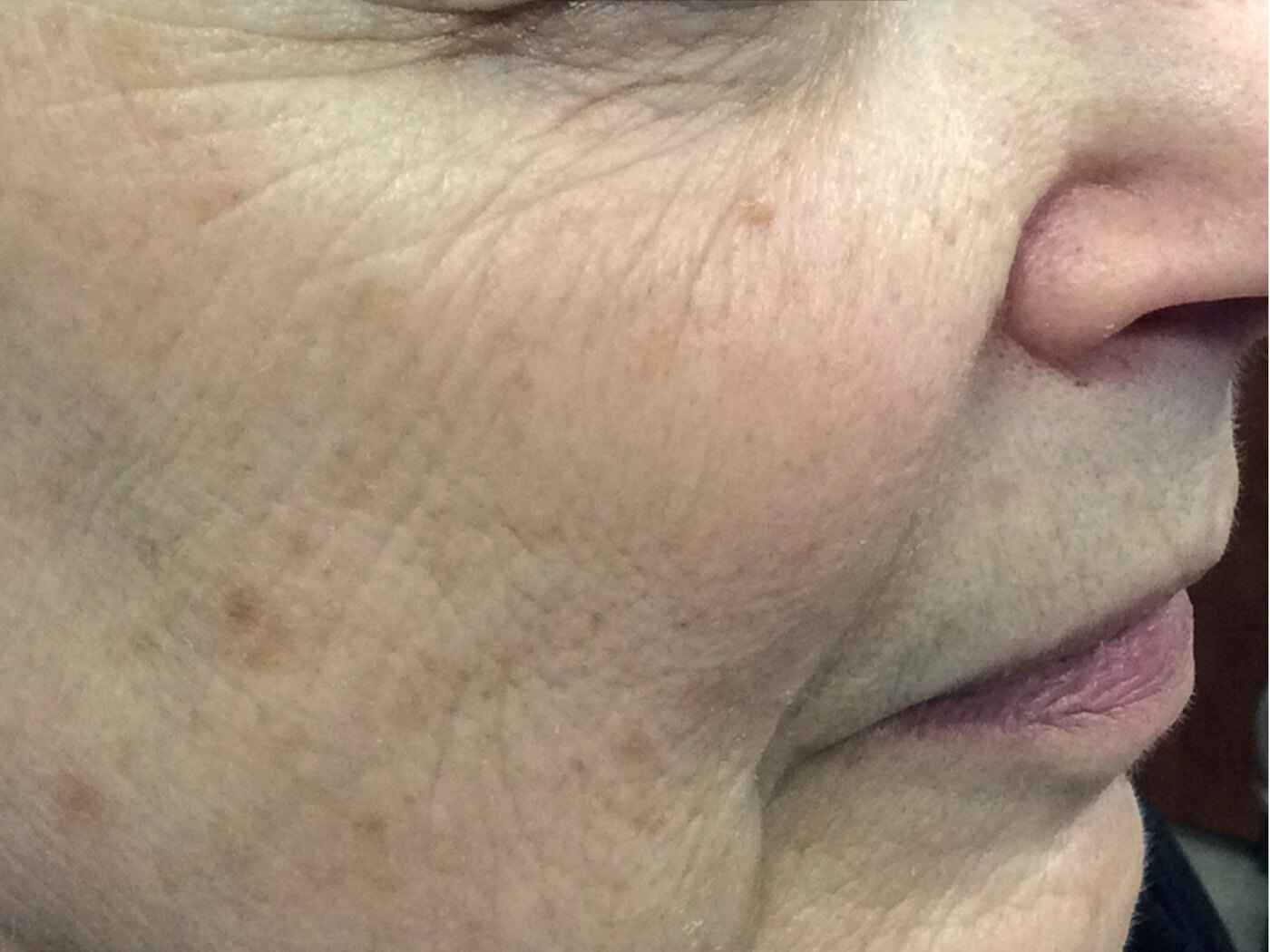 Before laser treatment showing visible creasing and texture around the cheek.