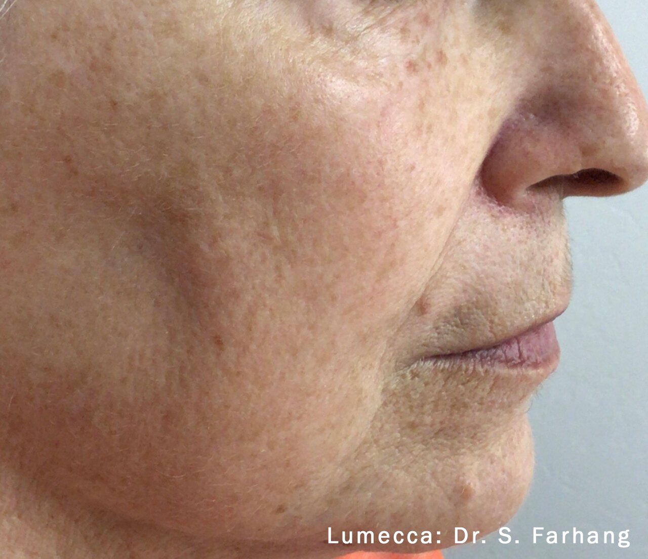 Lumecca IPL result showing improved cheek tone and texture.