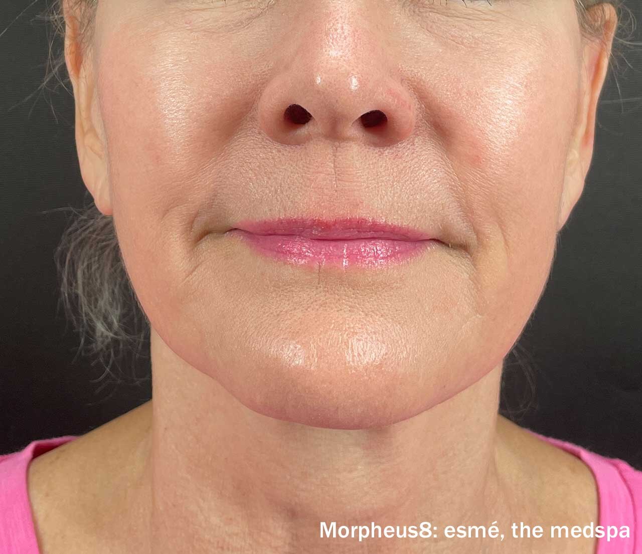 Morpheus8 treatment result showing a firmer lower-face contour.