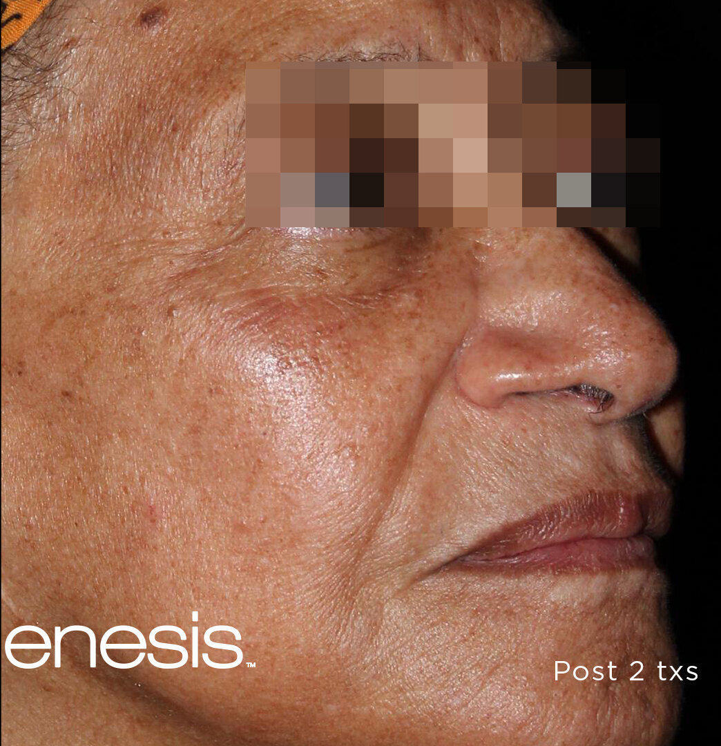 Pico Genesis result showing lighter pigmentation and more even skin tone.