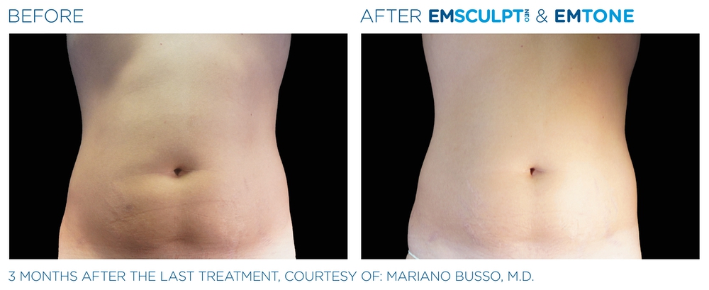 Emsculpt NEO before and after — male abdomen, Miami Skin Spa in Brickell; individual results vary