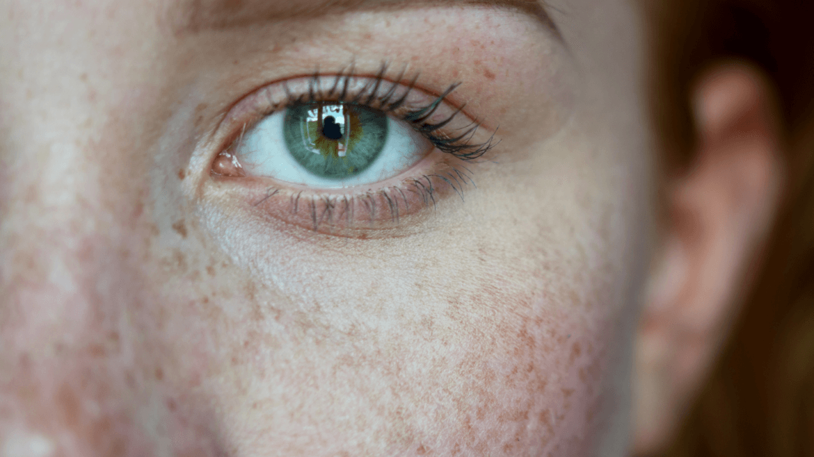 Causes and Treatments For Skin Discoloration at Miami Skin Spa in Brickell Causes and Treatments For Skin Discoloration at Miami Skin Spa in Brickell