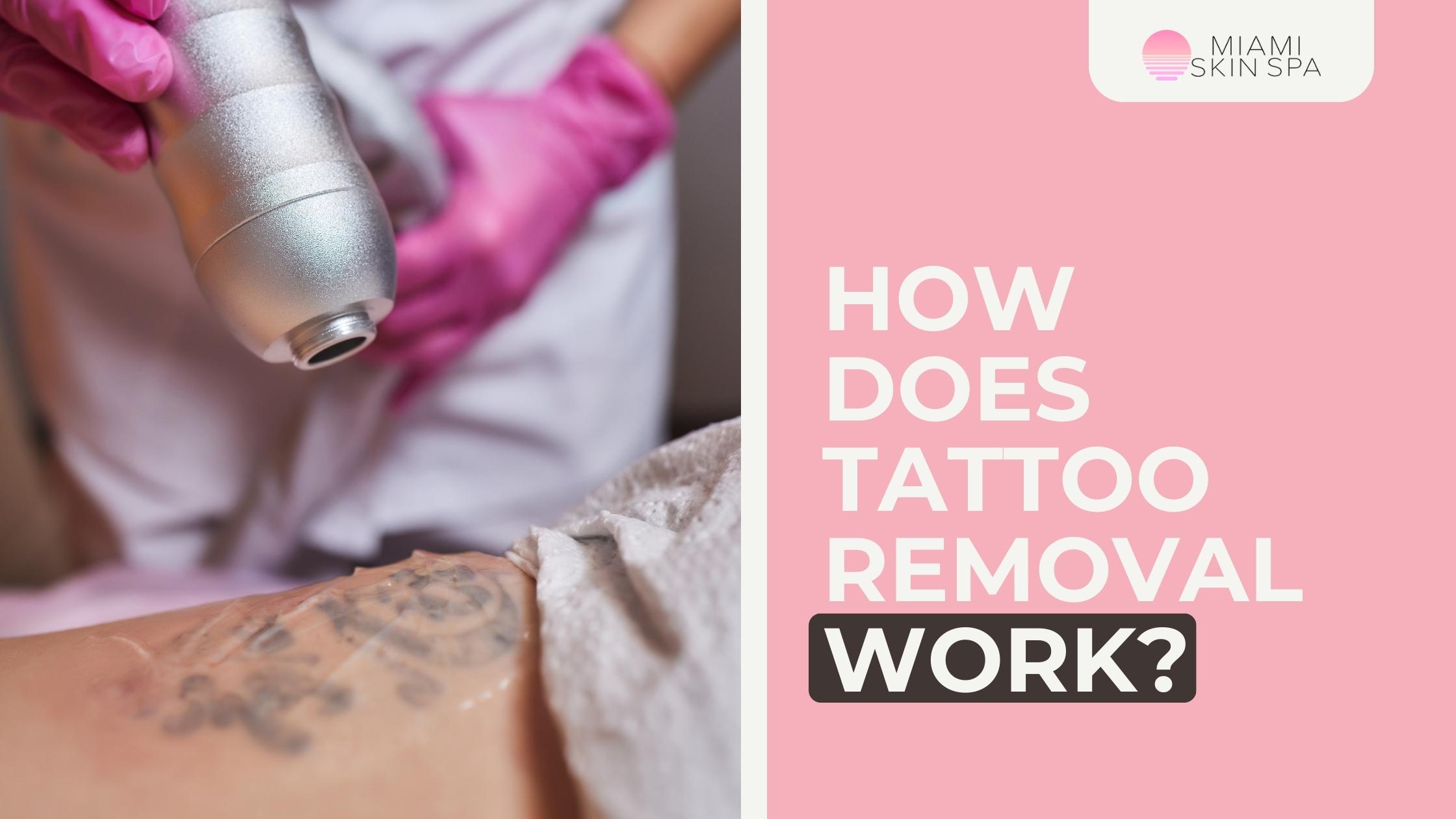 How laser tattoo removal works — ink shattered into particles the immune system clears, at Miami Skin Spa in Brickell.