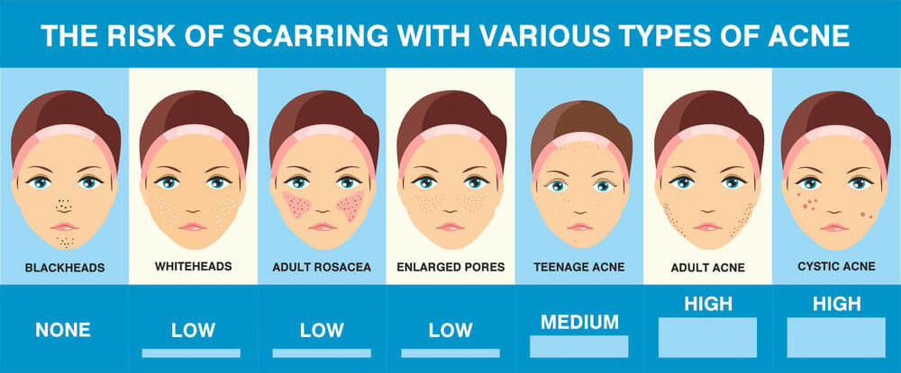 The risk of scarring with various types of acne from blackheads to cystic acne The risk of scarring with various types of acne from blackheads to cystic acne