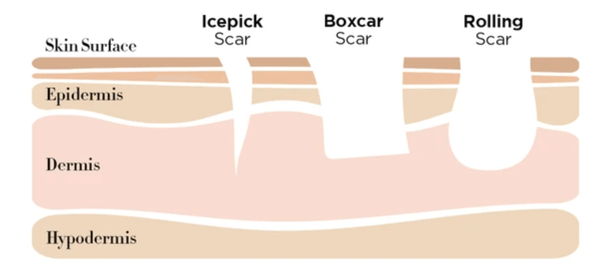 Atrophic acne scar cross-section diagram showing icepick, boxcar, and rolling scars at different skin depths Atrophic acne scar cross-section diagram showing icepick, boxcar, and rolling scars at different skin depths