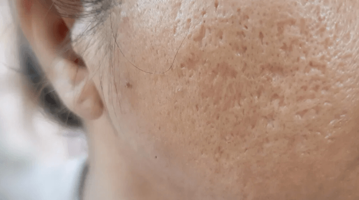 Close-up clinical photo of boxcar acne scars showing wide, pitted depressions Close-up clinical photo of boxcar acne scars showing wide, pitted depressions