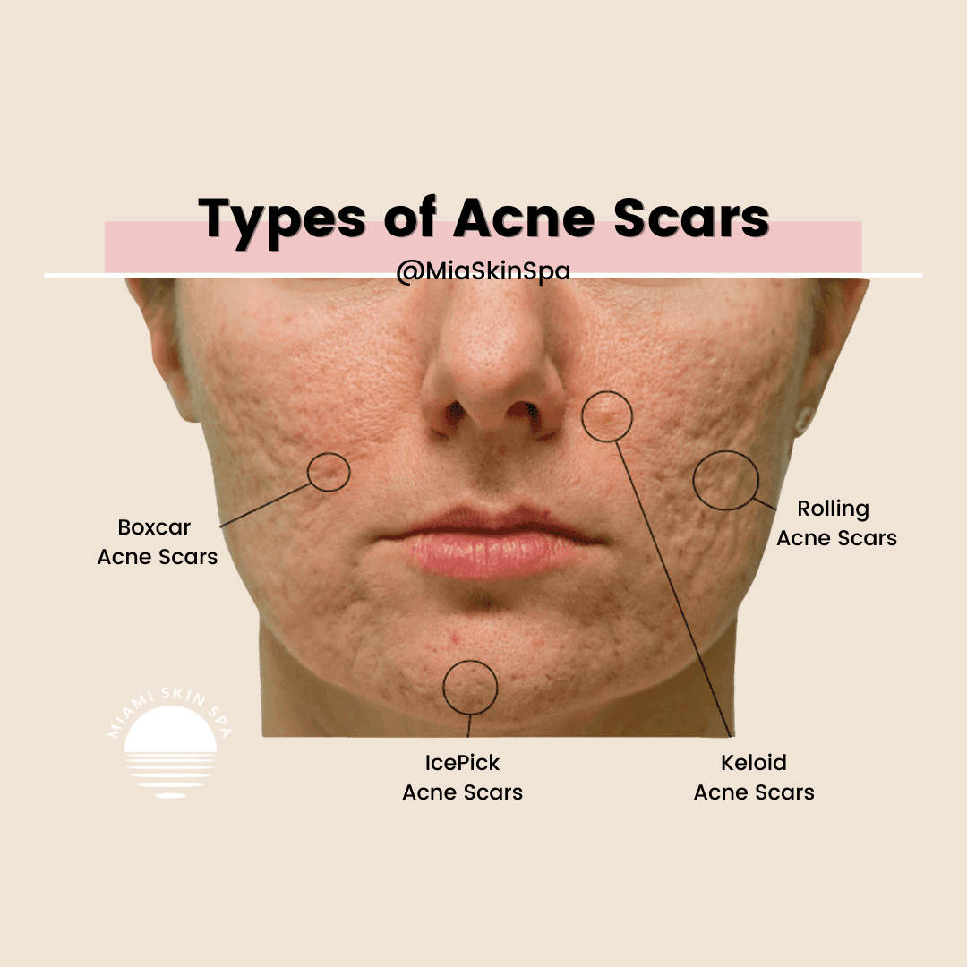 Types of acne scars mapped on a face showing where boxcar, rolling, icepick, and keloid scars typically appear Types of acne scars mapped on a face showing where boxcar, rolling, icepick, and keloid scars typically appear