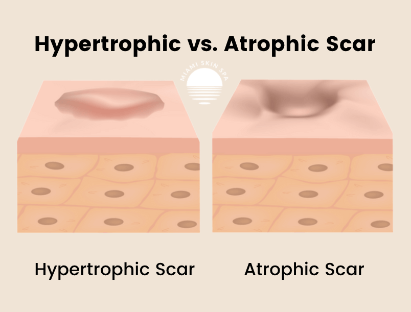 Hypertrophic vs atrophic scar comparison showing 3D skin cross-sections Hypertrophic vs atrophic scar comparison showing 3D skin cross-sections