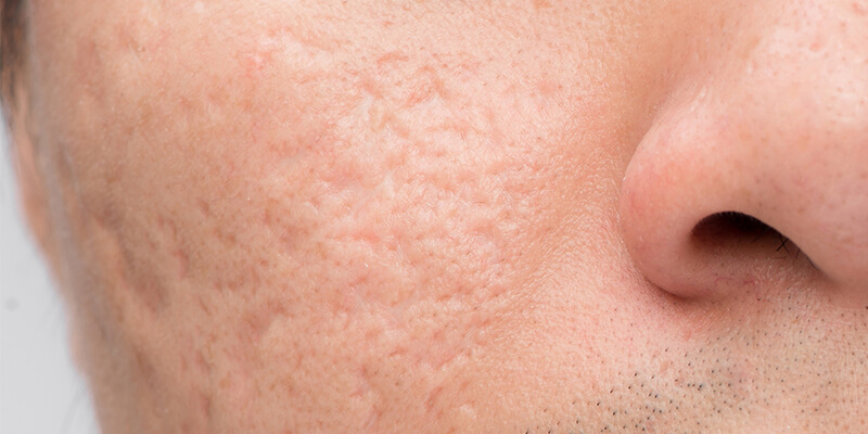 Close-up clinical photo of icepick acne scars showing deep, narrow pits in the skin Close-up clinical photo of icepick acne scars showing deep, narrow pits in the skin