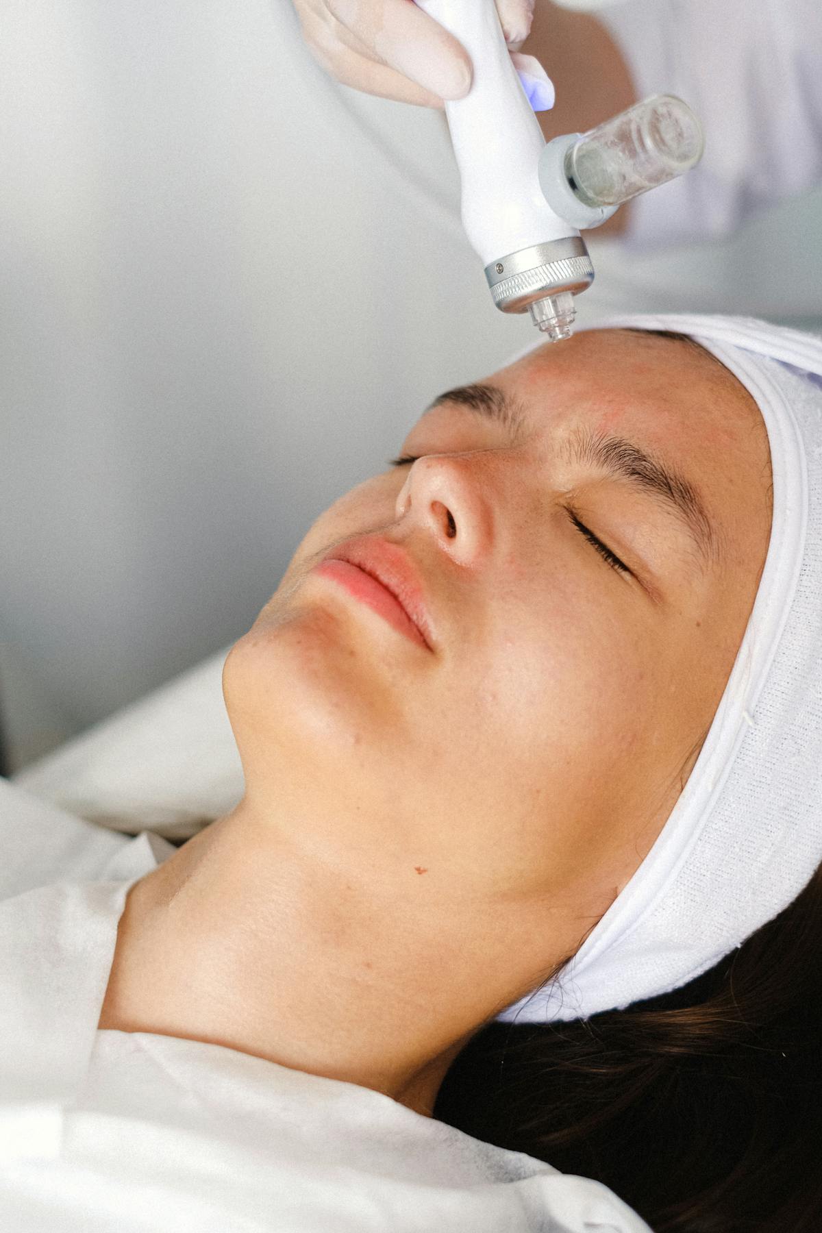 Microneedling treatment for acne scar removal at Miami Skin Spa Microneedling treatment for acne scar removal at Miami Skin Spa