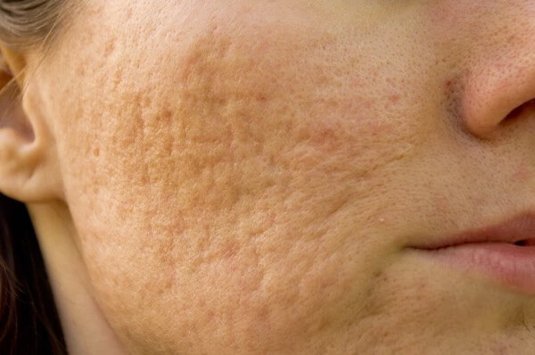 Close-up clinical photo of rolling acne scars on a cheek Close-up clinical photo of rolling acne scars on a cheek