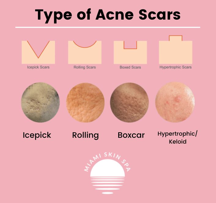 Type of Acne Scars — icepick, rolling, boxcar, and hypertrophic with cross-sections and clinical photos Type of Acne Scars — icepick, rolling, boxcar, and hypertrophic with cross-sections and clinical photos