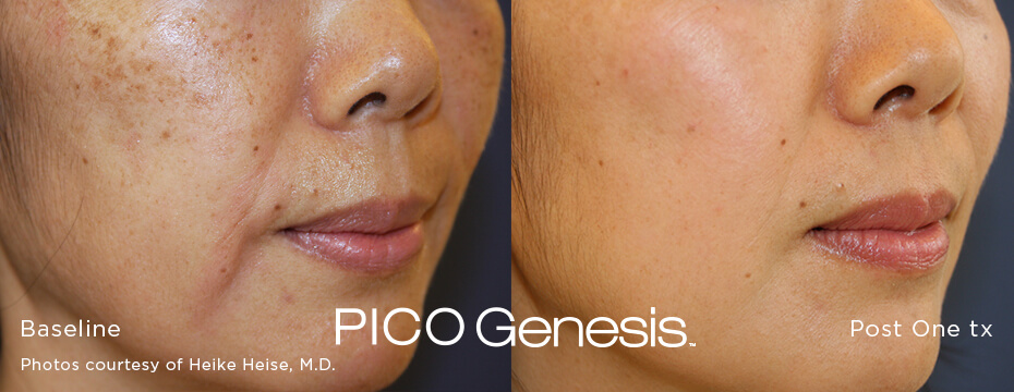 Pico Genesis laser treatment for pigment and tone at Miami Skin Spa in Miami.