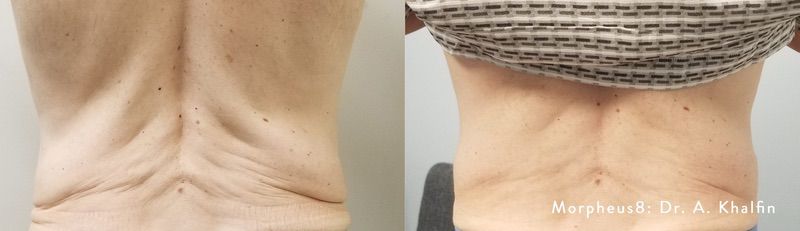 How to Tighten Loose Skin After Weight Loss at Miami Skin Spa in Brickell How to Tighten Loose Skin After Weight Loss at Miami Skin Spa in Brickell