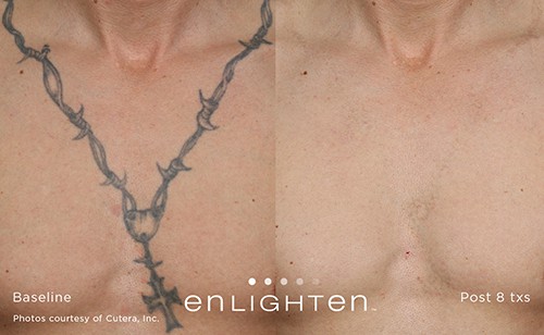 Decorative tattoo treated with laser tattoo removal at Miami Skin Spa in Brickell