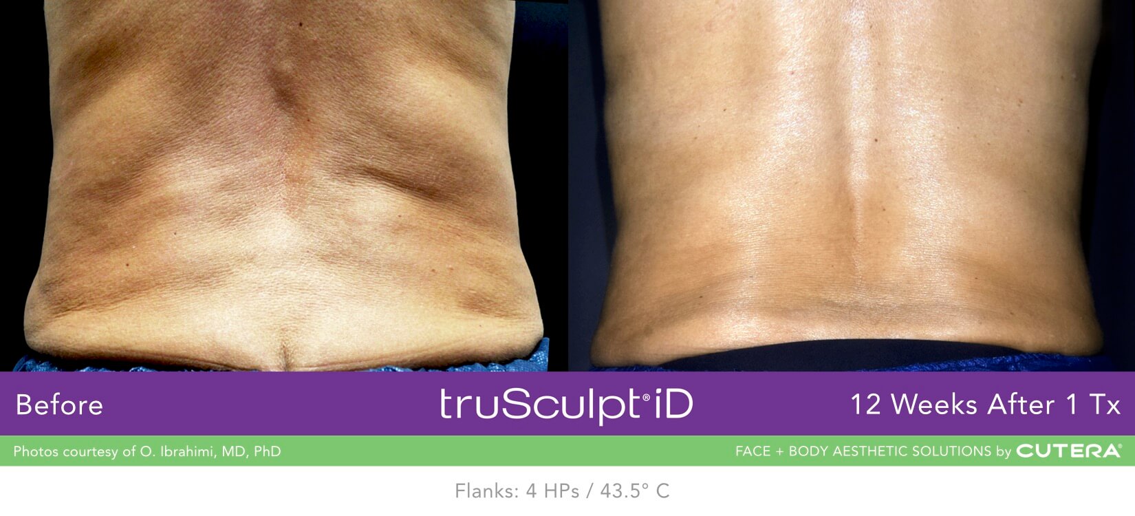 truSculpt iD applicators placed on the back for fat reduction at Miami Skin Spa, Miami