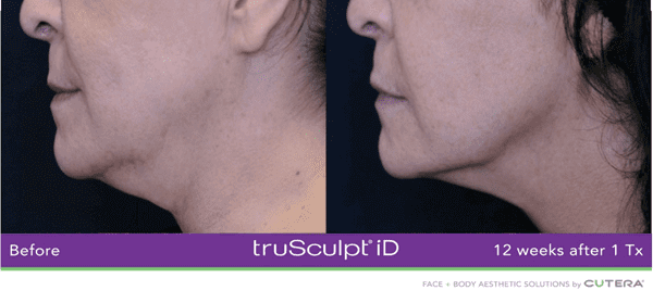 truSculpt iD submental treatment for double chin fat at Miami Skin Spa, Brickell