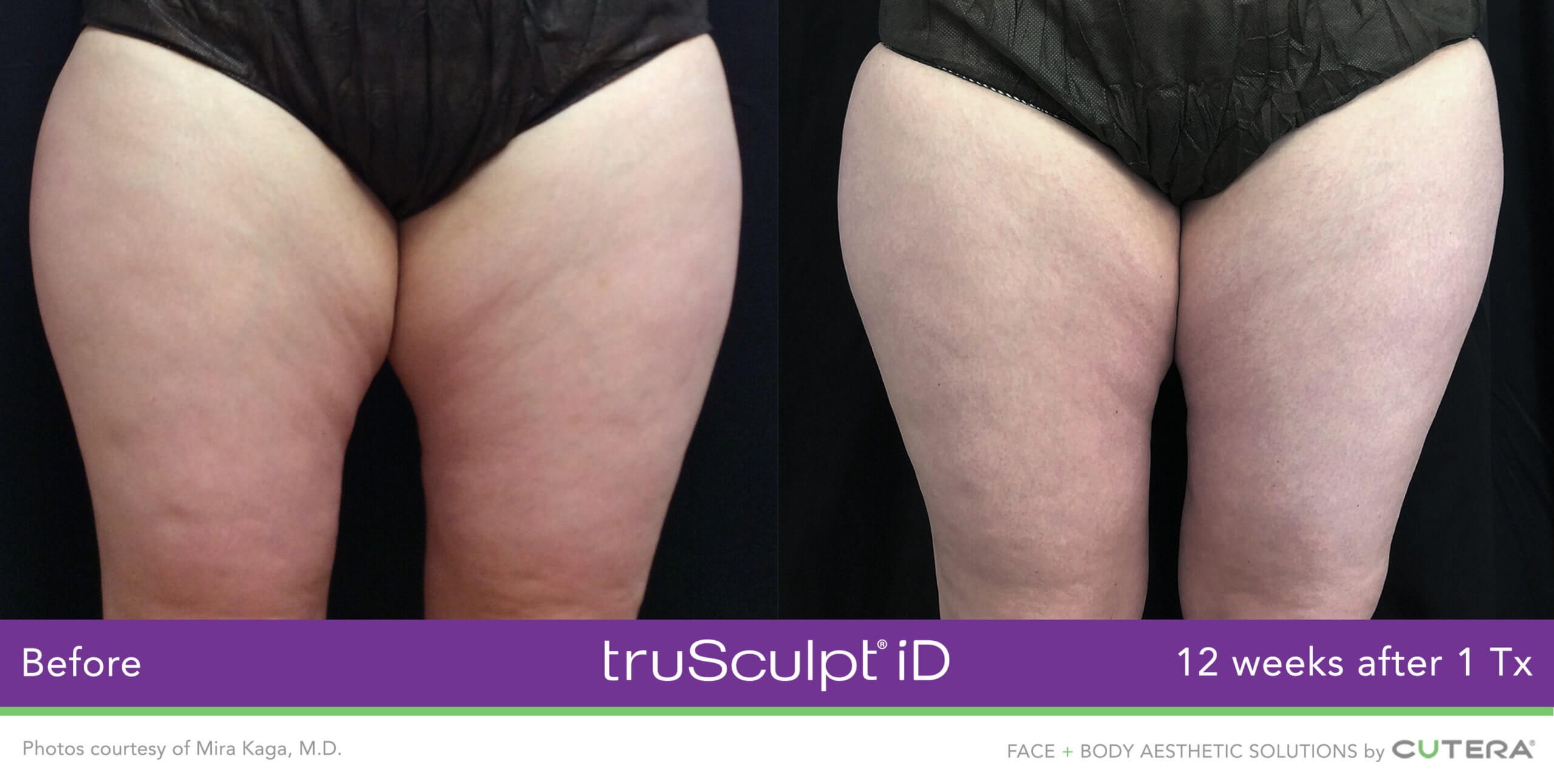 truSculpt iD body-contouring treatment in progress at Miami Skin Spa, Brickell