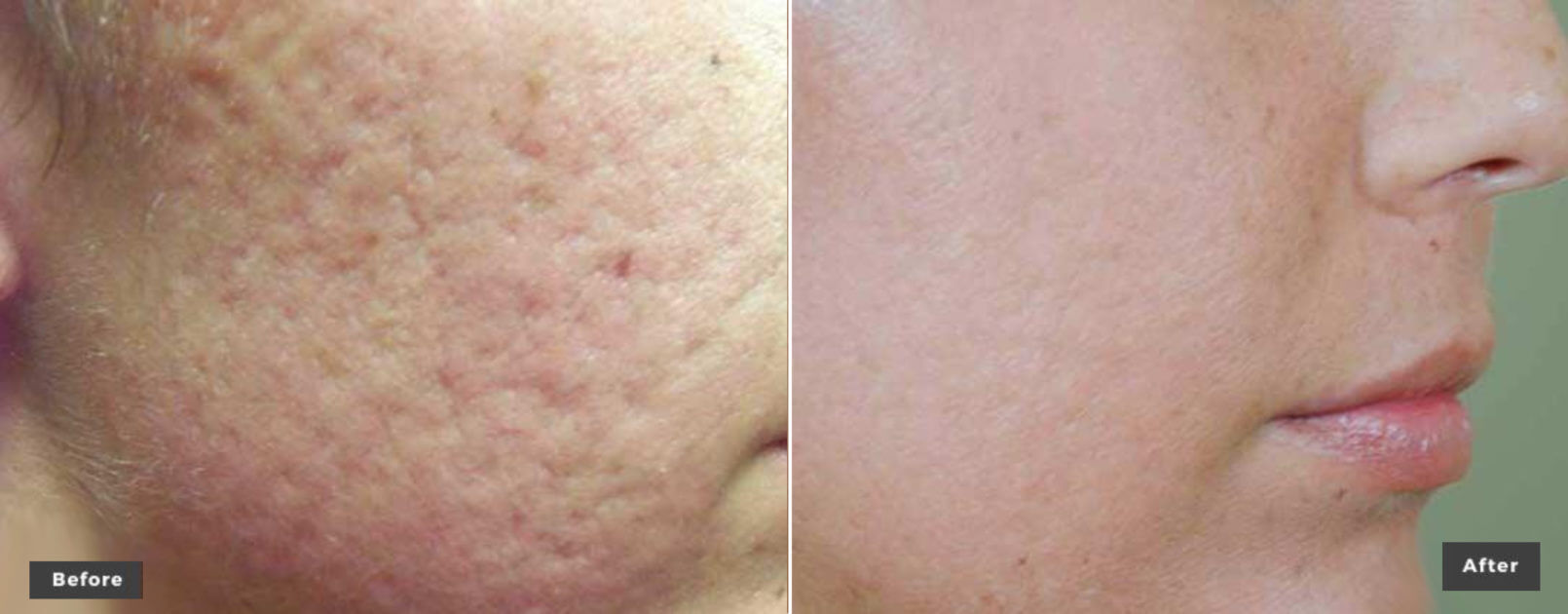 Skin revitalization from laser genesis body treatment at Miami Skin Spa, Brickell.
