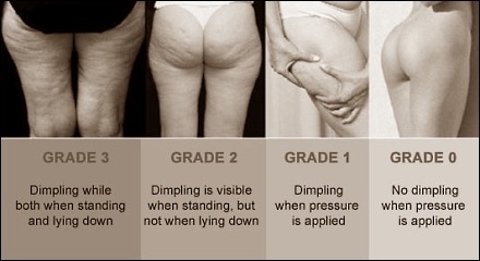 Cellulite grading scale (Grade 0 to Grade 3) used at Miami Skin Spa in Brickell to assess dimpling severity and plan treatment