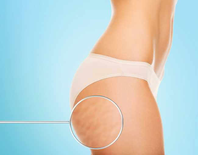 Cellulite reduction at Miami Skin Spa Brickell — smoother, firmer skin without surgery