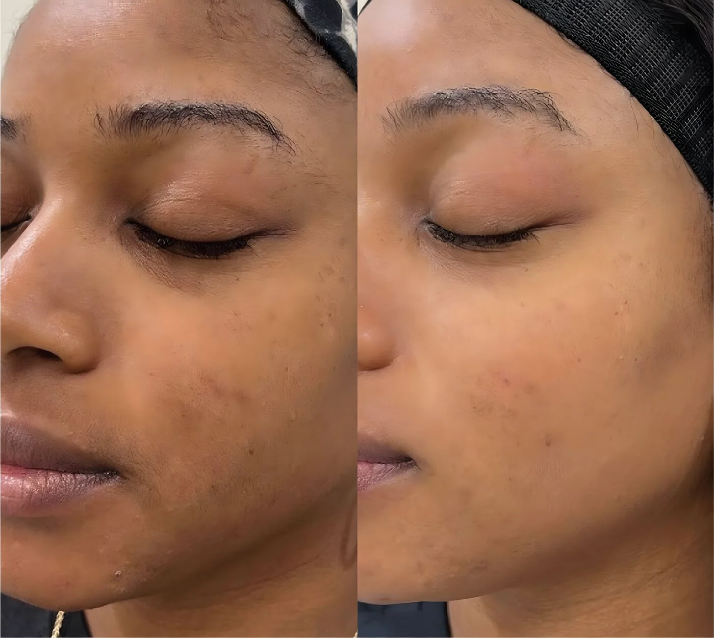 Uneven cheek tone improved after a chemical peel series