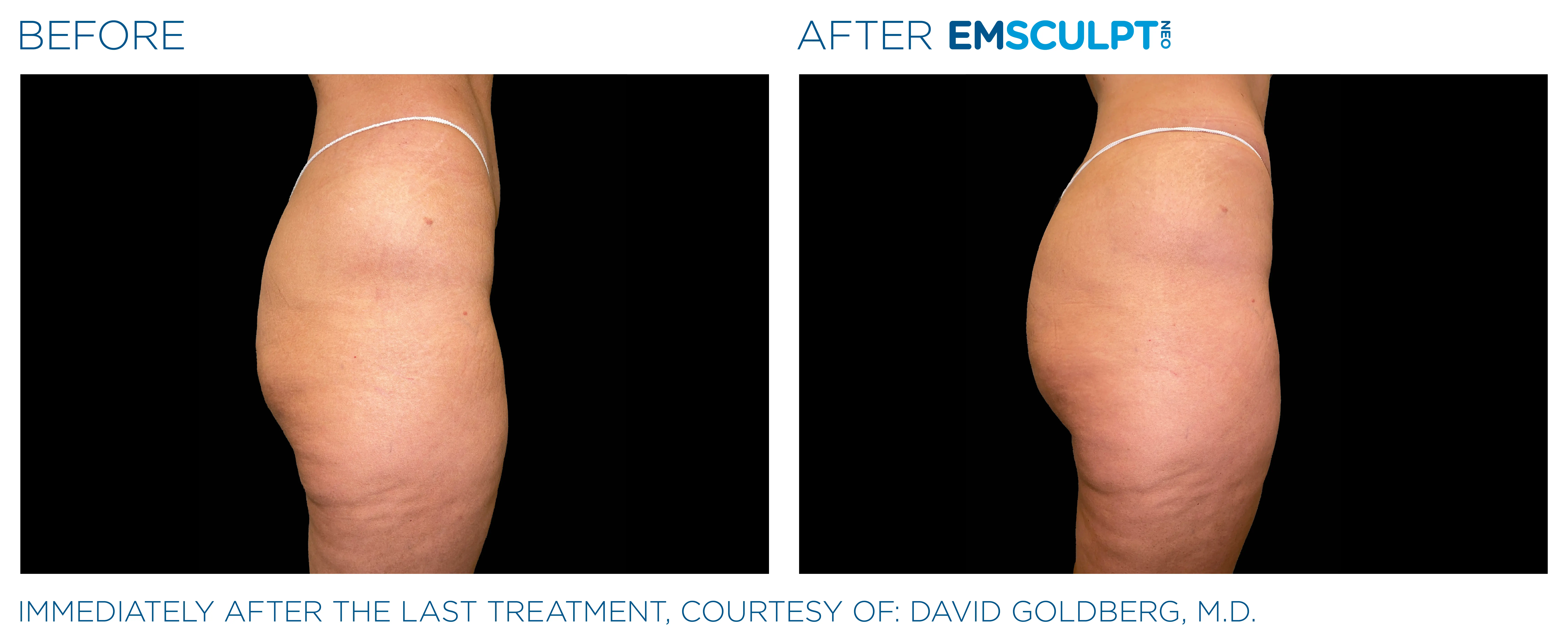 Emsculpt Neo before and after result showing improved buttock contour.