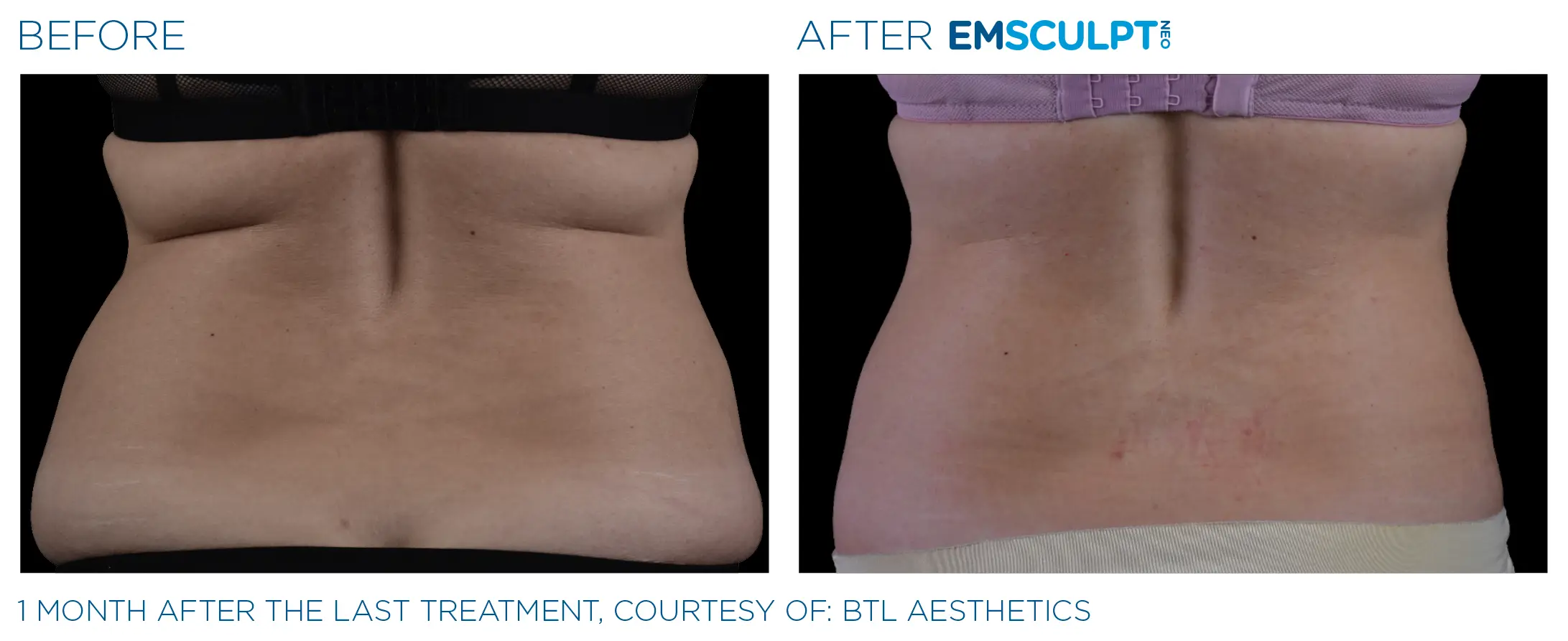 Emsculpt Neo before and after side-profile result showing improved waistline contour.
