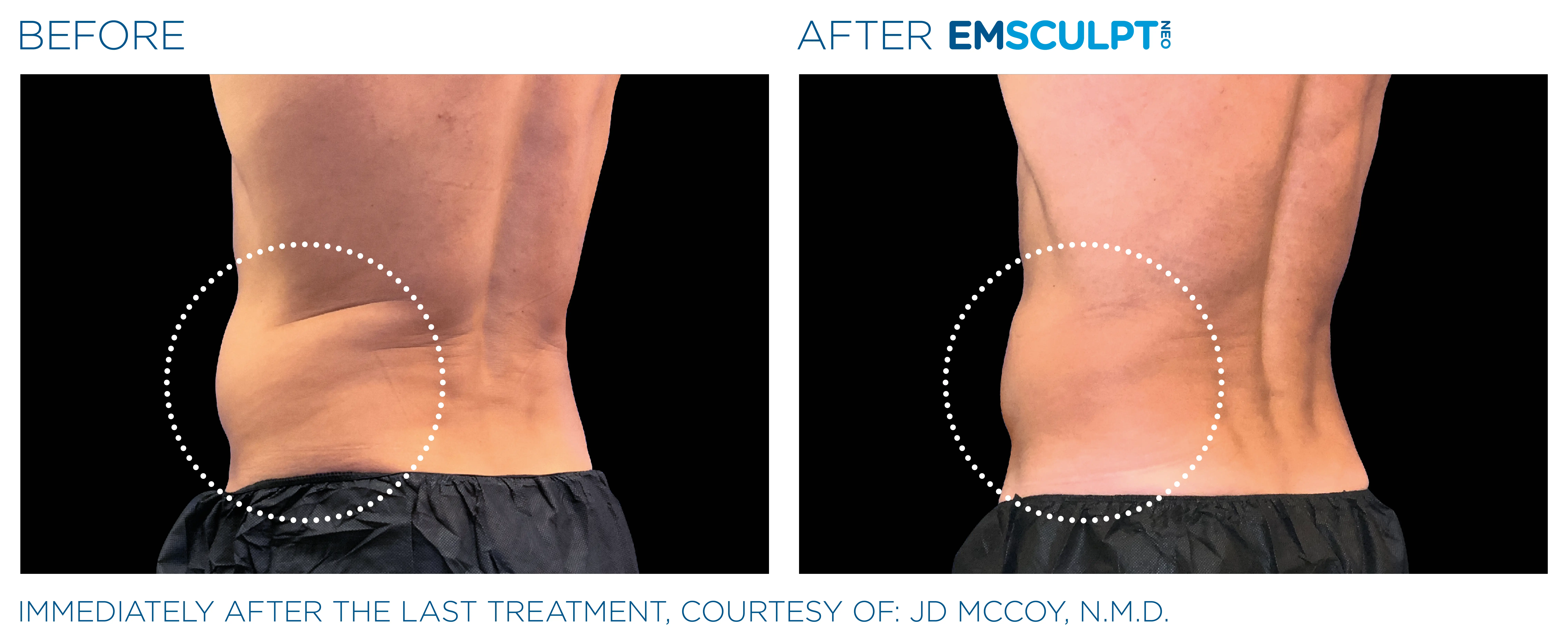 Emsculpt Neo before and after male lateral-abdomen result showing a leaner contour.
