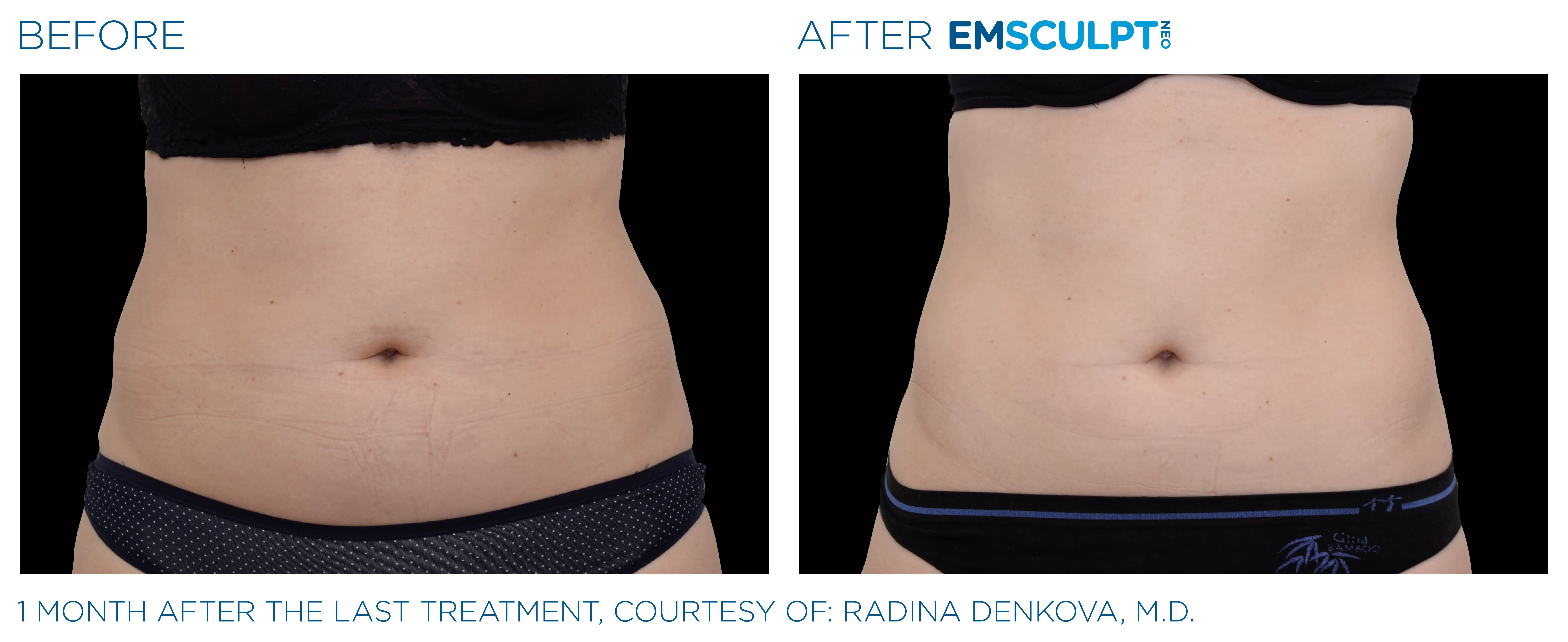 Emsculpt NEO at Miami Skin Spa in Brickell — before and after on female abdomen