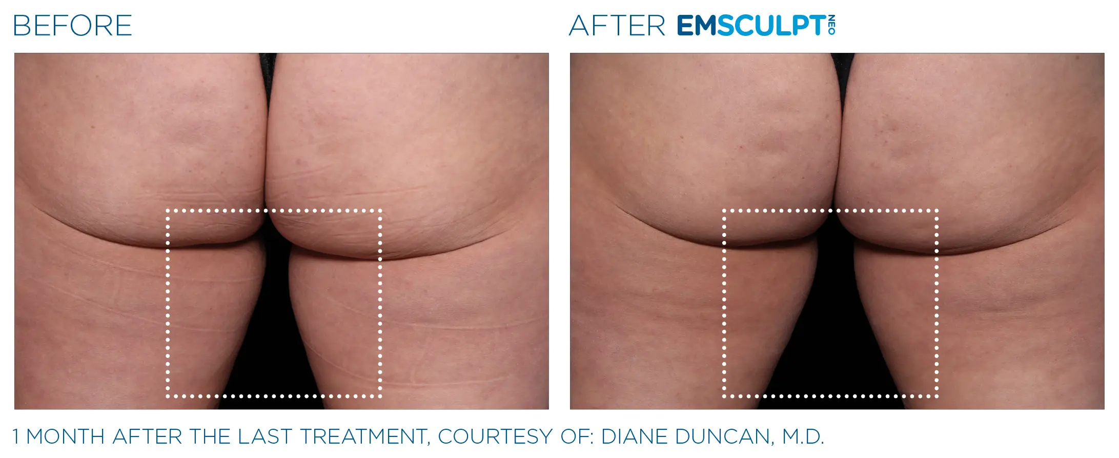 Emsculpt Neo before and after inner-thigh result showing improved contour.