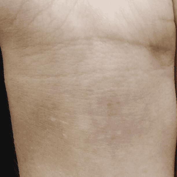 Same tattoo faded after a laser tattoo removal series at Miami Skin Spa in Brickell.