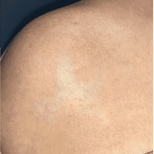 Same tattoo cleared after a laser tattoo removal series at Miami Skin Spa in Brickell.
