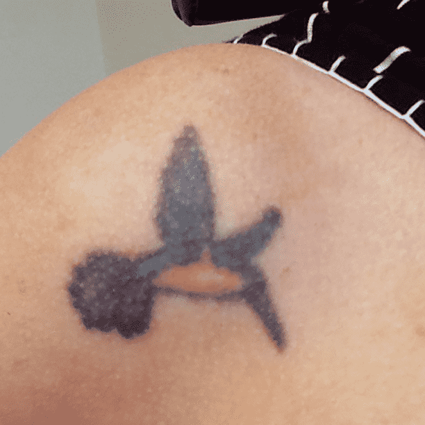 Tattoo before laser removal at Miami Skin Spa in Brickell.