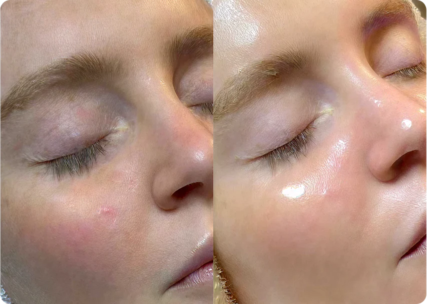 HydraFacial before and after result showing a brighter glow and smoother cheek texture.