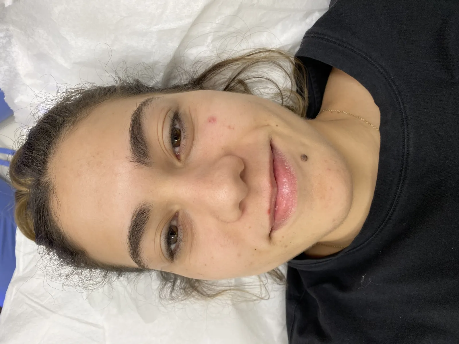 HydraFacial treatment in progress at Miami Skin Spa in Brickell, Miami.