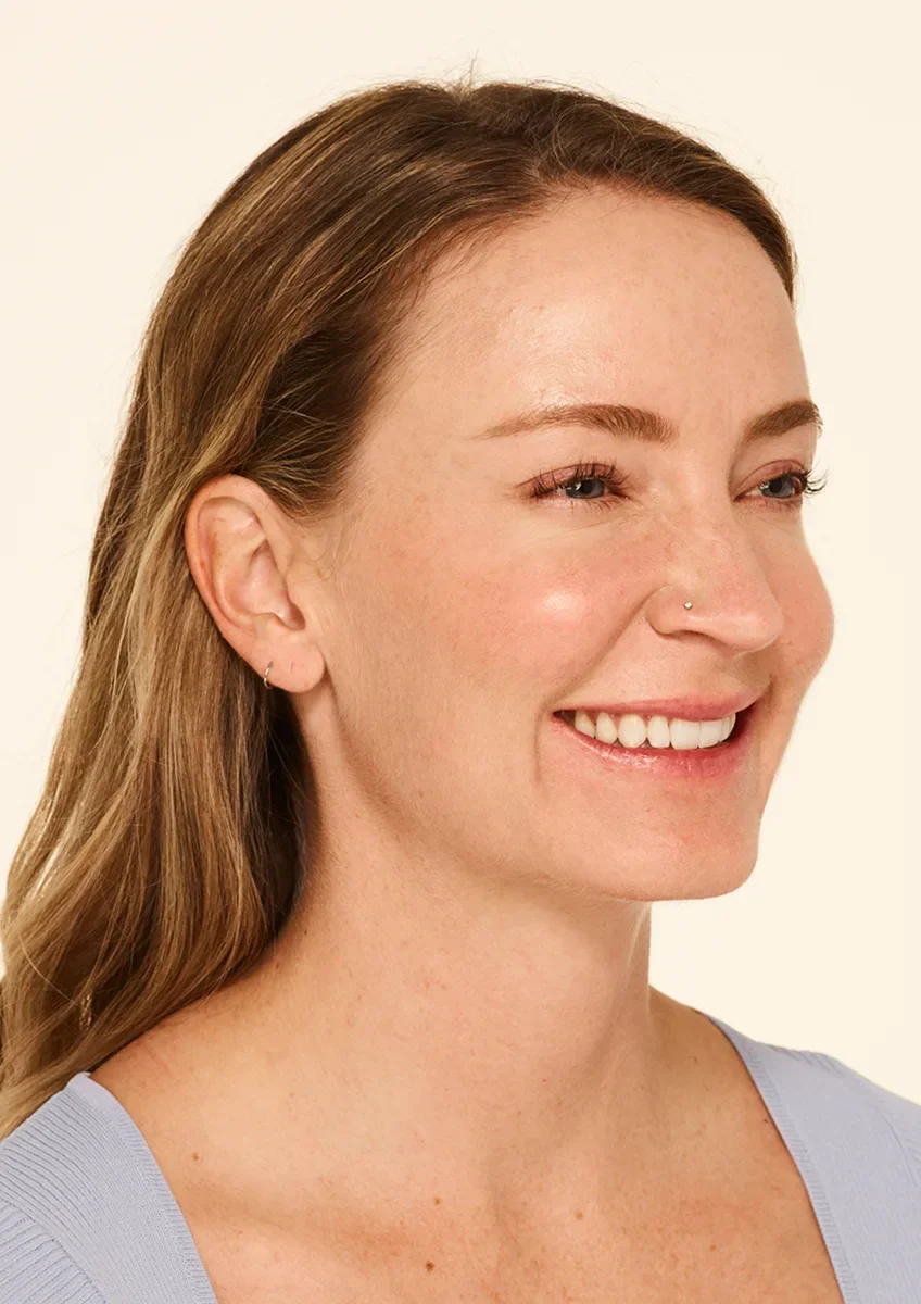 Mandy 30 days after wrinkle relaxer — softened crow's feet