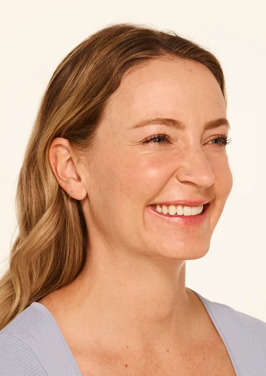 Mandy before wrinkle relaxer treatment — visible crow's feet