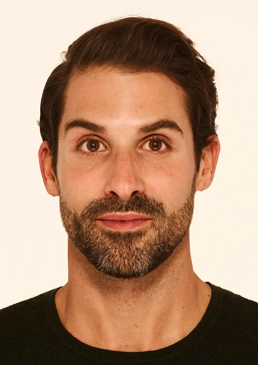 Stephen 30 days after Botox — smoothed forehead
