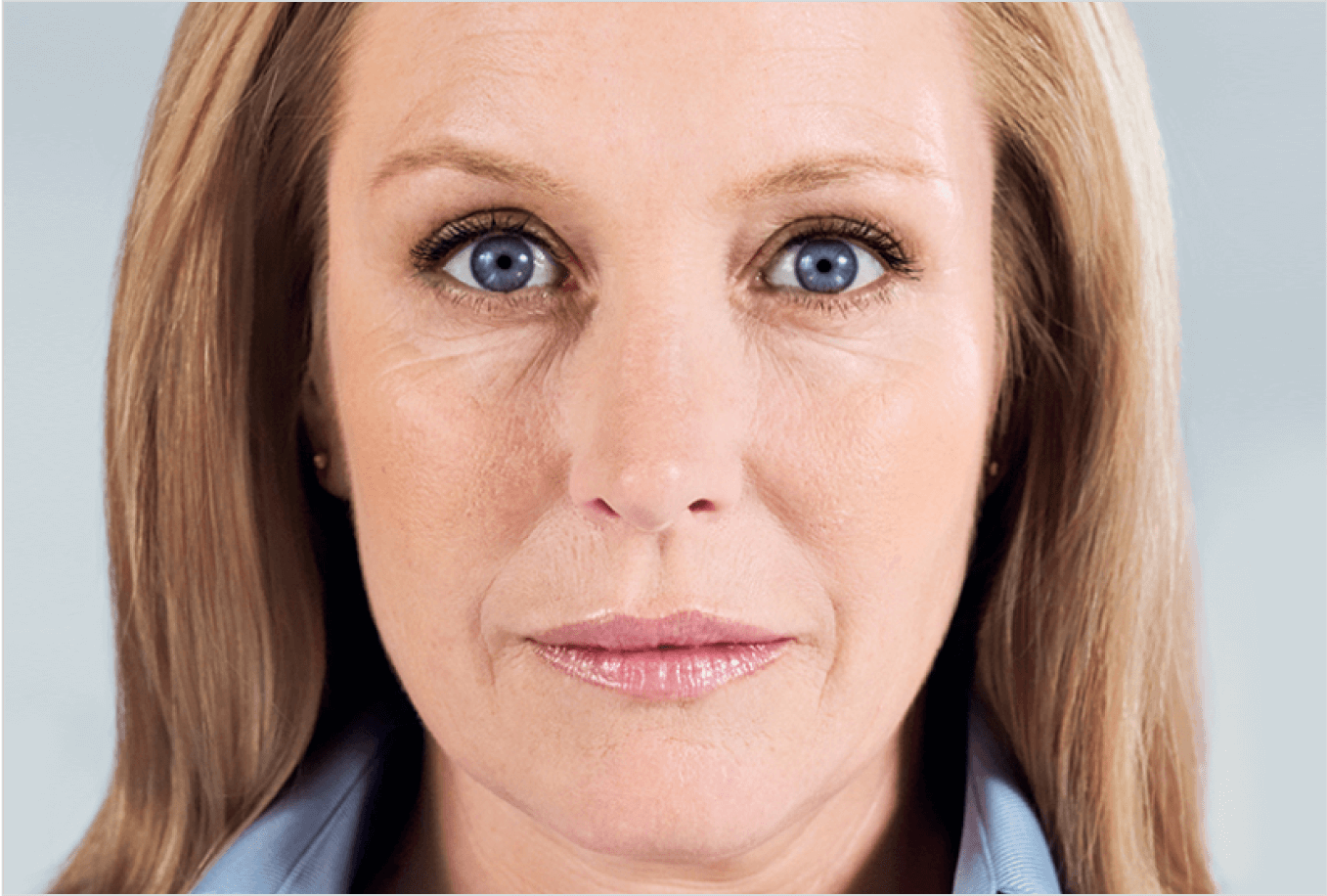 Elissa after Sculptra collagen treatment — improved jawline contour
