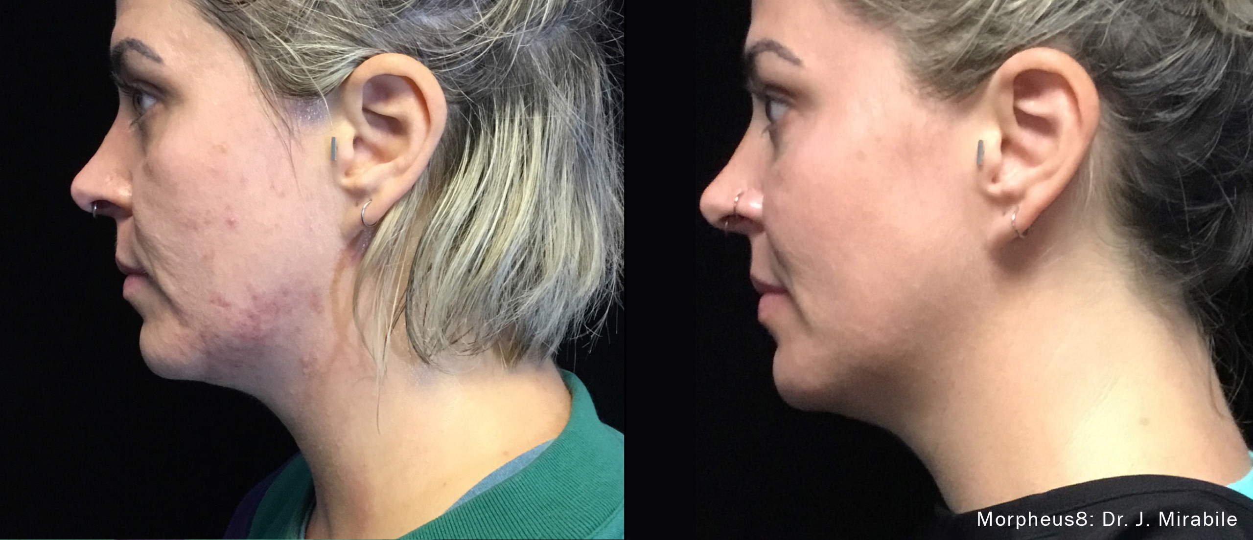 Morpheus8 before and after comparison showing the jawline from a side angle.