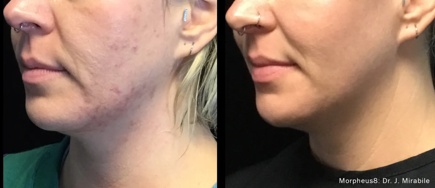 Morpheus8 before and after comparison focused on tightening under the chin and upper neck.