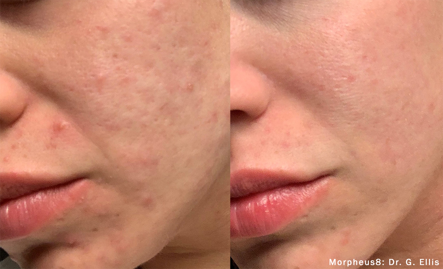 Morpheus8 before and after cheek result showing clearer texture and smoother skin.