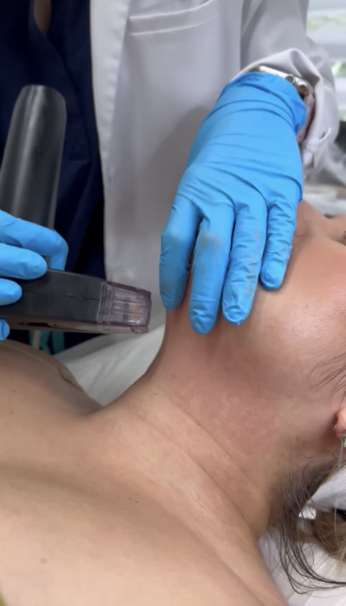 Morpheus8 Neck Treatment Miami Radiofrequency microneedling handpiece treating the neck during a session at Miami Skin Spa in Brickell, Miami