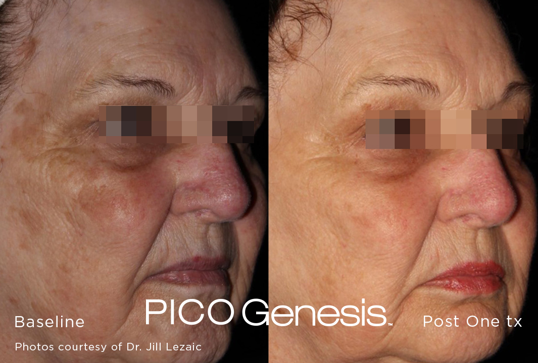 Pico Genesis before and after result showing reduced age spots across the cheek and temple.