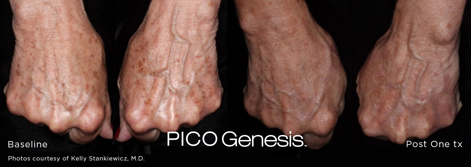 Pico Genesis before and after comparison focused on evening out pigmentation through the mid-face.