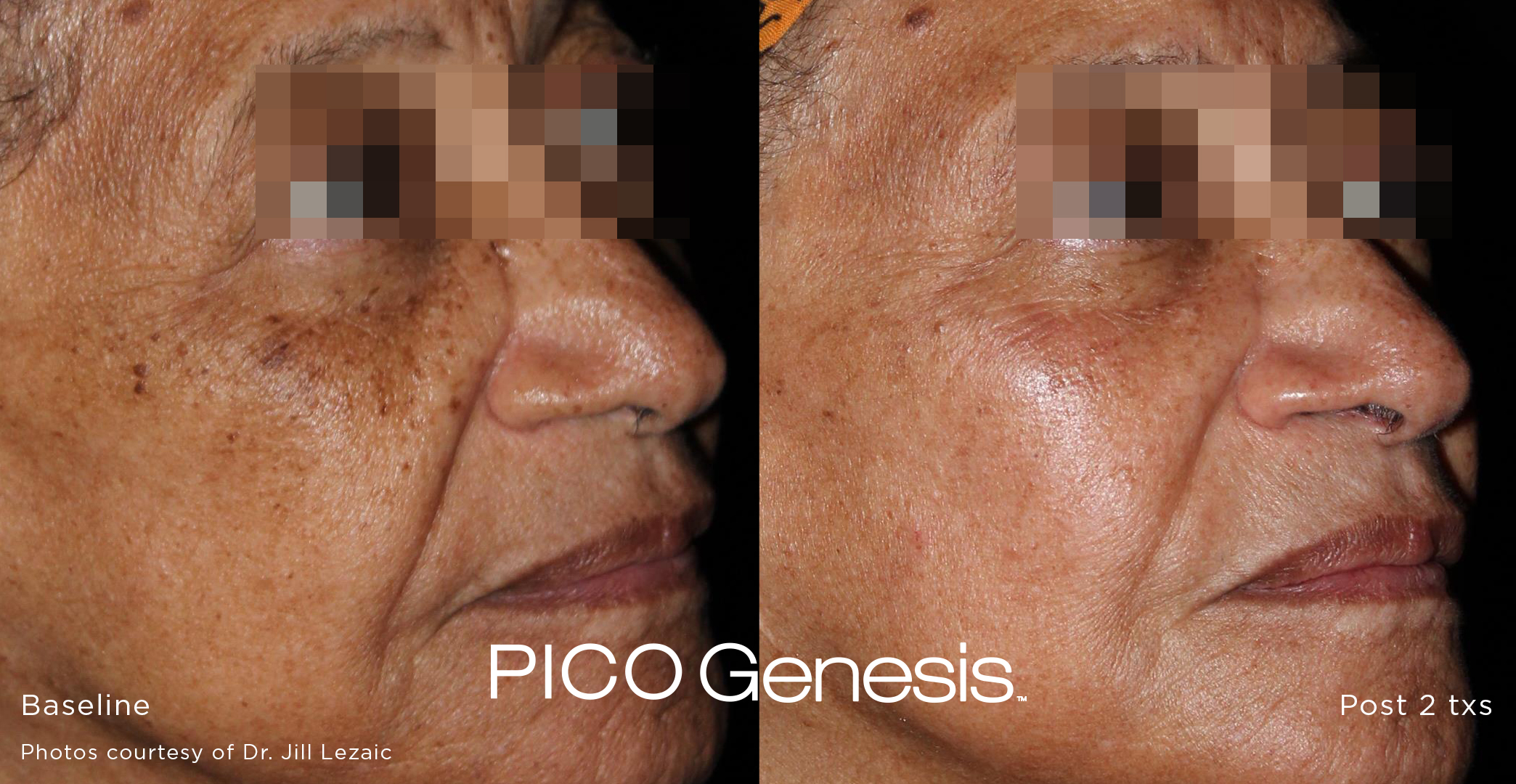 Pico Genesis before and after result showing softer pigmentation across the full face.