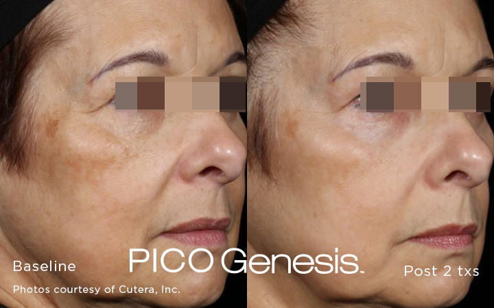 PICO Genesis Laser at Miami Skin Spa in Brickell — pigmentation reduction results