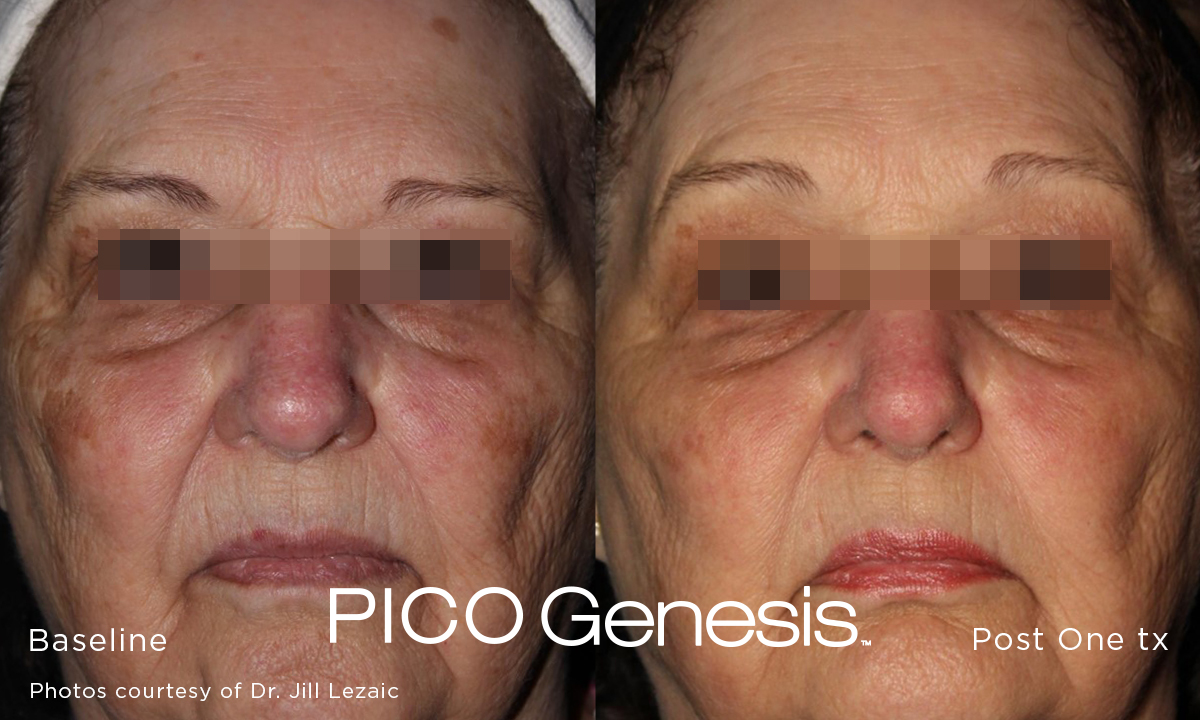 Pico Genesis before and after result showing softer sun damage on the cheek and under-eye area.